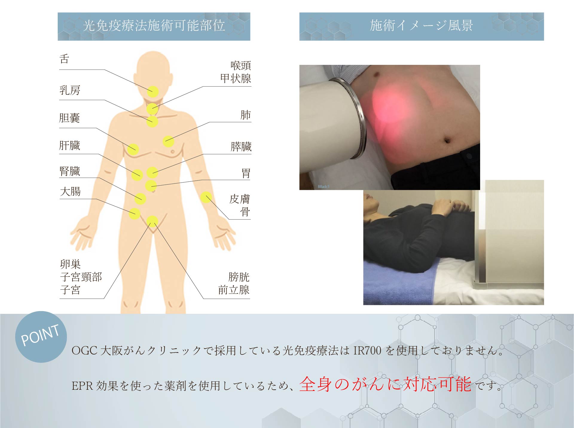 OGCの光免疫療法は全身に対応