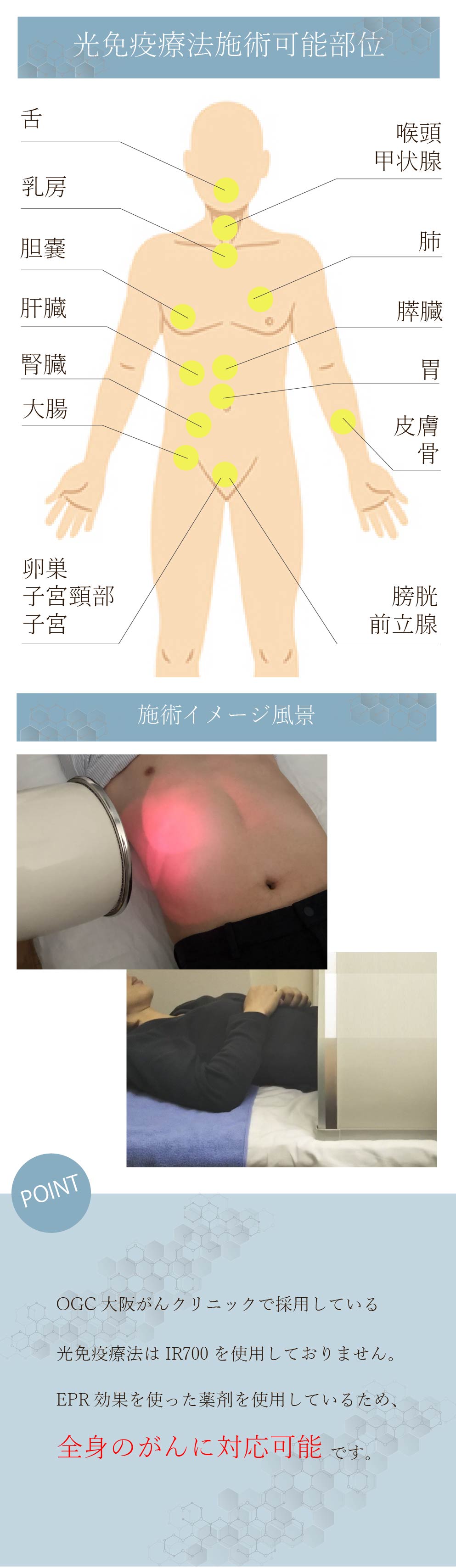 OGCの光免疫療法は全身に対応